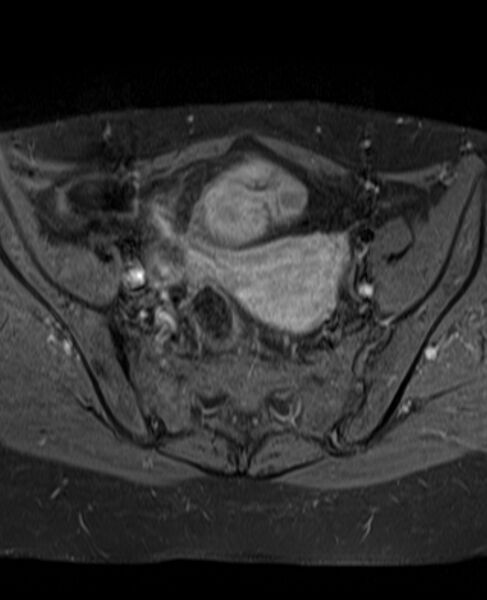 File:Adult granulosa cell tumor of the ovary (Radiopaedia 71581-81950 Axial T1 C+ fat sat 11).jpg