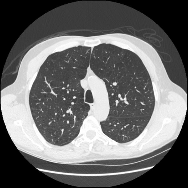 File:Alpha-1-antitrypsin deficiency (Radiopaedia 40993-43722 Axial lung window 70).jpg