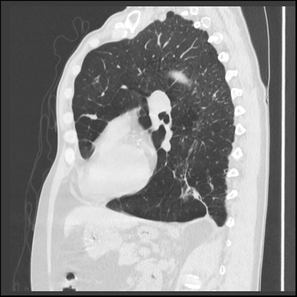 File:Alpha-1-antitrypsin deficiency (Radiopaedia 40993-43722 Sagittal lung window 108).jpg
