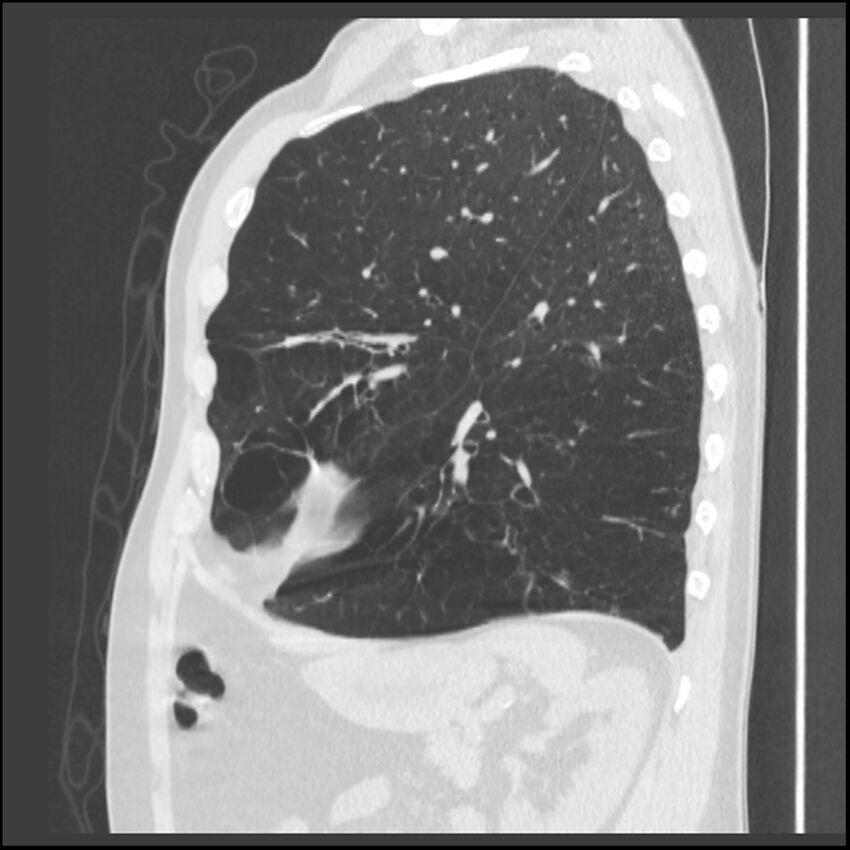 Alpha-1-antitrypsin deficiency (Radiopaedia 40993-43722 Sagittal lung window 80).jpg