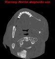 Ameloblastoma (Radiopaedia 13276-13280 Axial non-contrast 13).jpg