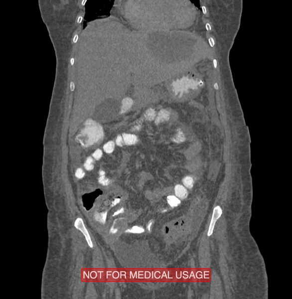 File:Amoebic enterocolitis with liver abscess (Radiopaedia 35100-36609 B 59).jpg