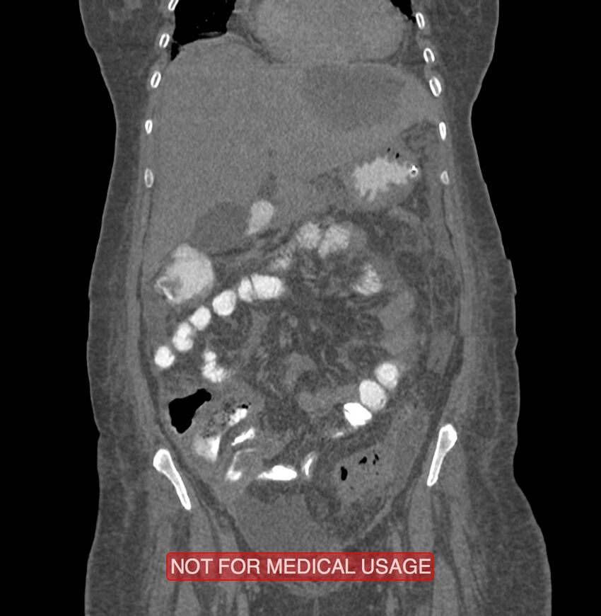 Amoebic enterocolitis with liver abscess (Radiopaedia 35100-36609 B 59).jpg