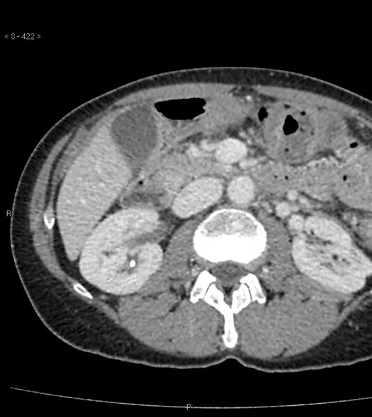 File:Ampulla of Vater metastasis (Radiopaedia 27820-28065 A 26).jpg