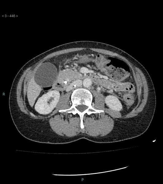File:Ampulla of Vater metastasis (Radiopaedia 27820-28069 A 84).jpg
