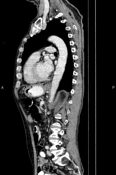 File:Ampullary adenocarcinoma (Radiopaedia 86093-102033 E 57).jpg
