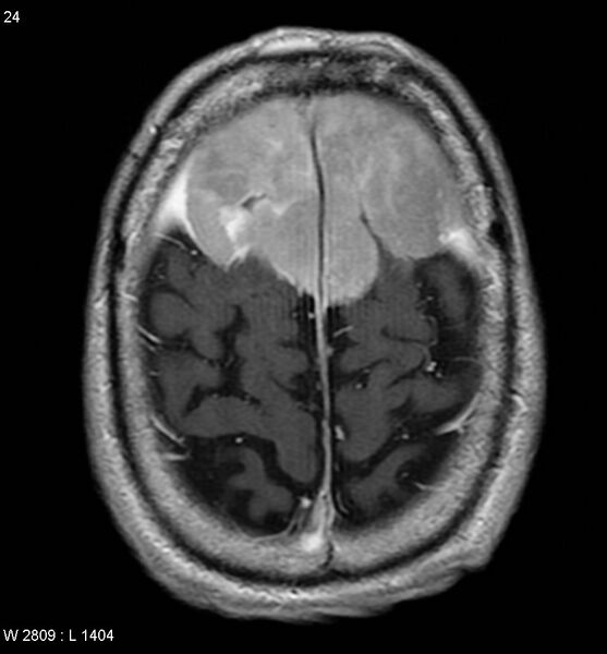 File:Anaplastic meningioma (Radiopaedia 5553-7290 Axial T1 C+ 1).jpg