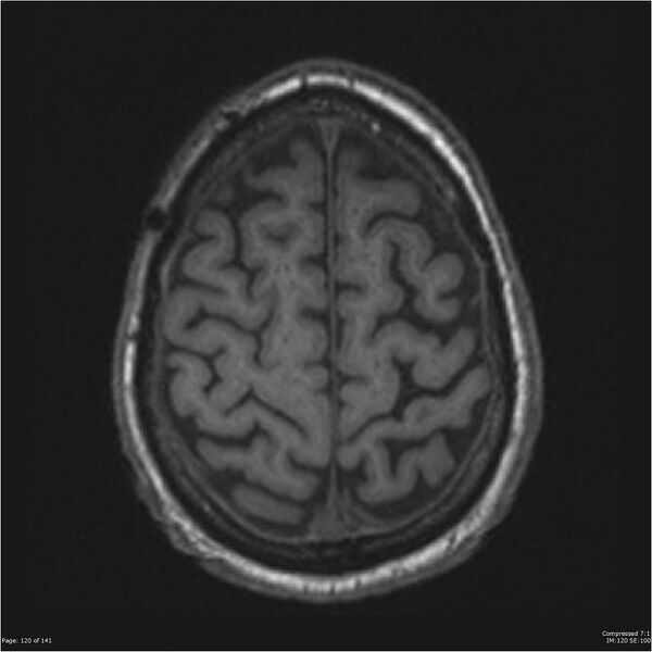 File:Anaplastic meningioma with recurrence (Radiopaedia 34452-35788 Axial T1 118).jpg