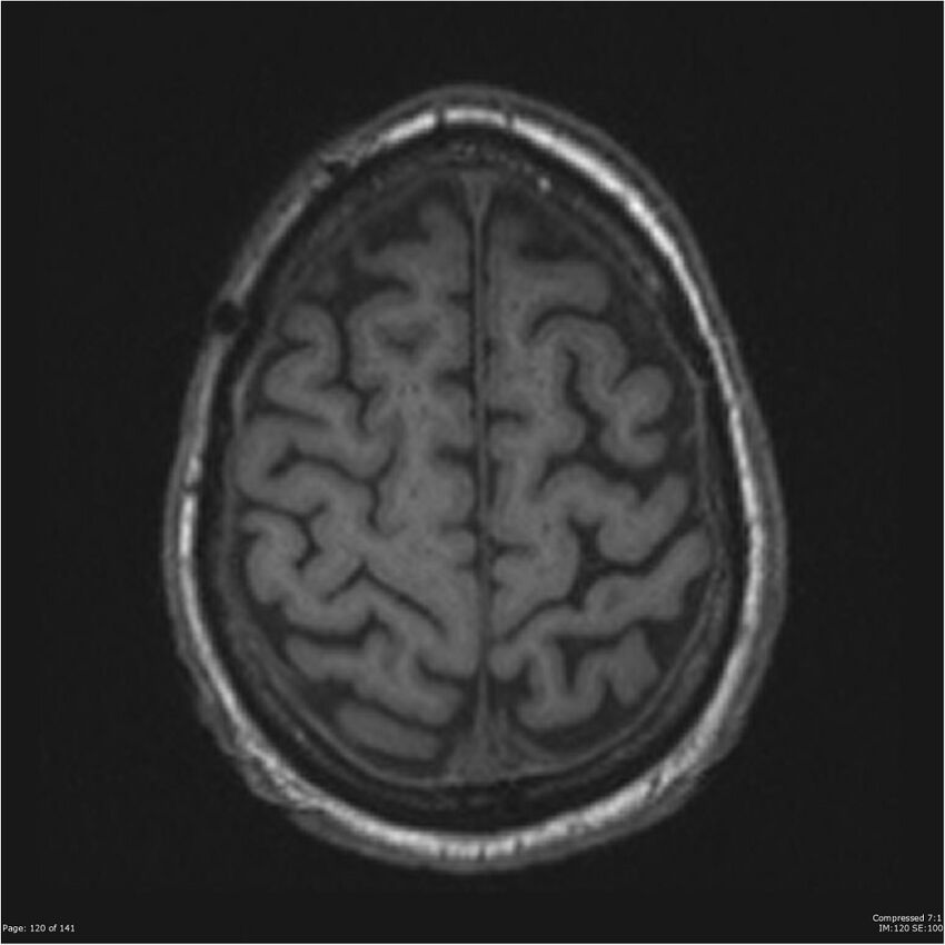 Anaplastic meningioma with recurrence (Radiopaedia 34452-35788 Axial T1 118).jpg