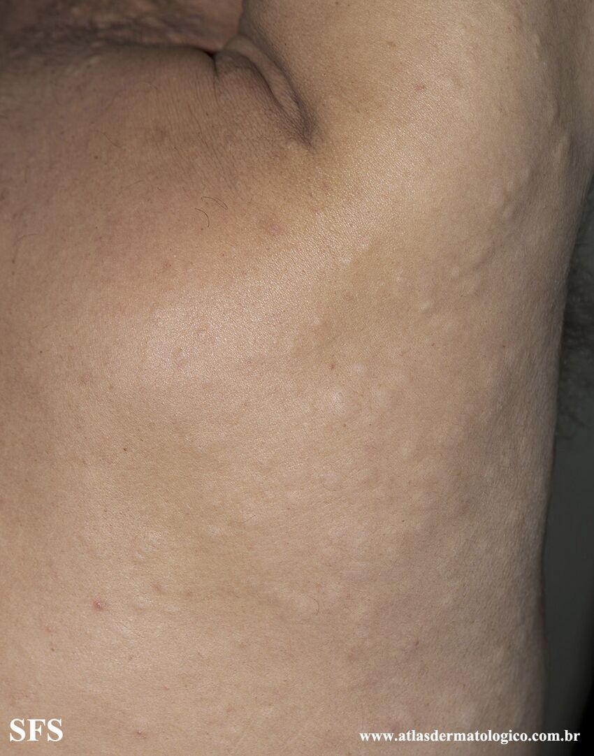 Anetoderma Jadassohn Pellizari (Dermatology Atlas 36).jpg