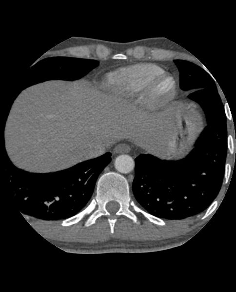 File:Anomalous coronary arteries (Radiopaedia 83979-99206 A 276).jpg