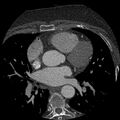 Anomalous origin of left circumflex artery from right coronary sinus (Radiopaedia 72563-83117 B 50).jpg