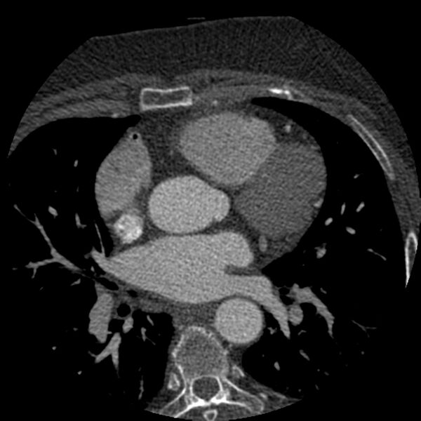 File:Anomalous origin of left circumflex artery from right coronary sinus (Radiopaedia 72563-83117 B 50).jpg