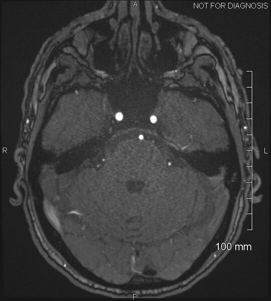 File:Anterior cerebral artery aneurysm (Radiopaedia 80683-94127 Axial MRA 66).jpg