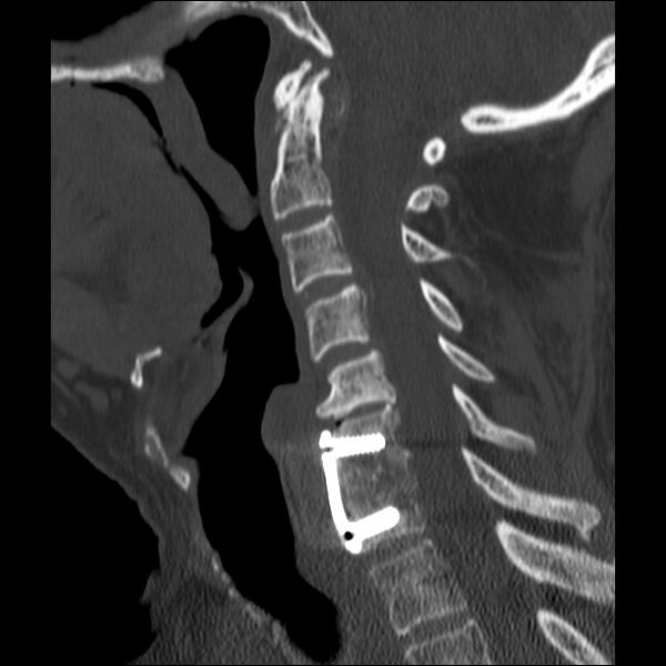 File:Anterior cervical postdiscectomy arthrodesis (Radiopaedia 32678-33646 Sagittal bone window 38).jpg