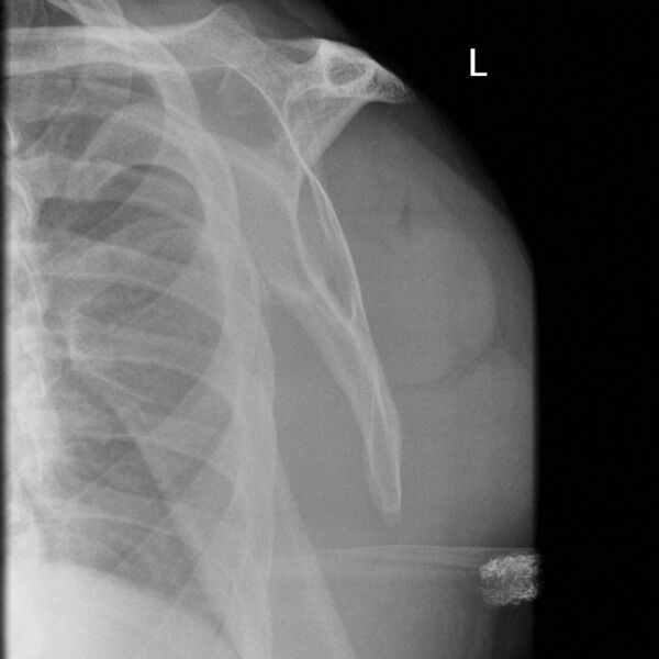 File:Anterior shoulder dislocation (Radiopaedia 9158-9858 Lateral 1).jpg