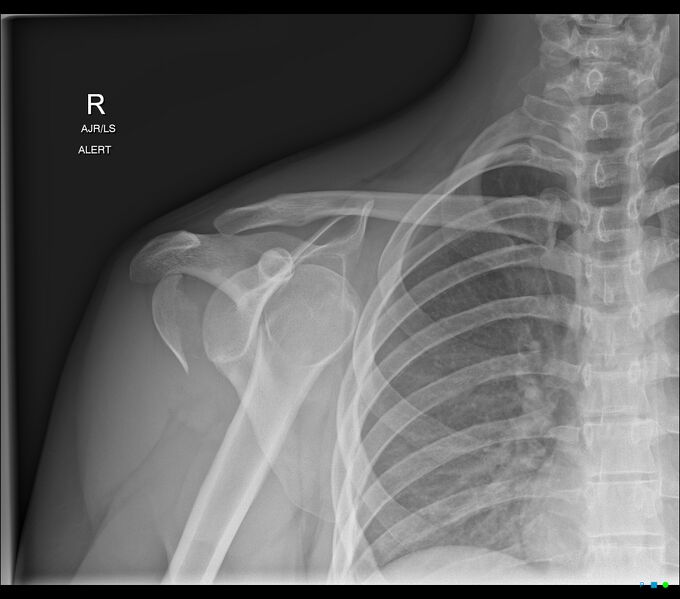 File:Anterior shoulder dislocation and humeral head fracture (Radiopaedia 77411-89535 Frontal 1).jpg