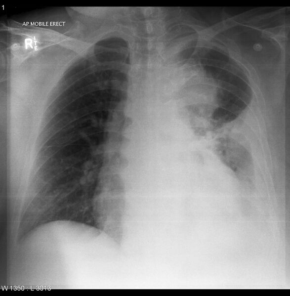 File:Aortic arch false aneurysm (Radiopaedia 14667-14586 Frontal 1).jpg