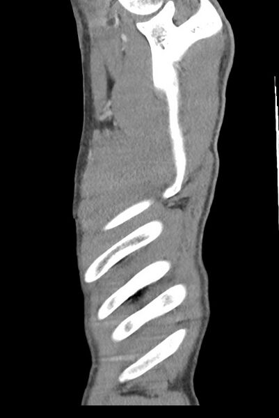 File:Aortic coarctation with aneurysm (Radiopaedia 74818-85828 B 149).jpg