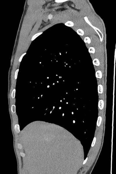 File:Aortic coarctation with aneurysm (Radiopaedia 74818-85828 B 39).jpg