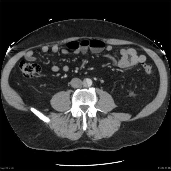 File:Aortic dissection- Stanford A (Radiopaedia 37759-39664 A 121).jpg