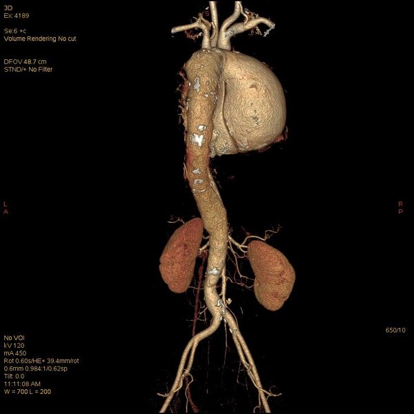 File:Aortic dissection (Radiopaedia 25350-25604 E 10).jpg