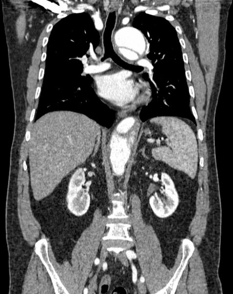 File:Aortic dissection (Radiopaedia 44411-48061 A 31).jpg