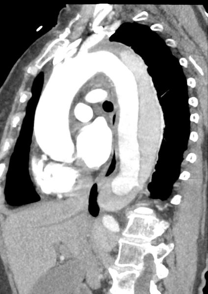 File:Aortic dissection - Stanford type B (Radiopaedia 50171-55512 C 29).png