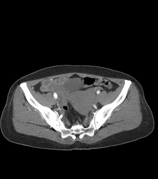 File:Aortic dissection with renal ischemia (Radiopaedia 76573-88338 A 97).jpg