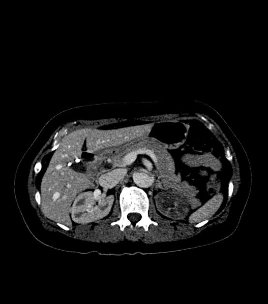 File:Aortic dissection with renal ischemia (Radiopaedia 76573-88338 B 30).jpg