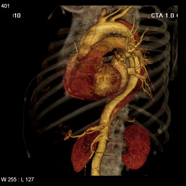File:Aortic dissection with rupture into pericardium (Radiopaedia 12384-12647 C+ arterial phase 33).jpg