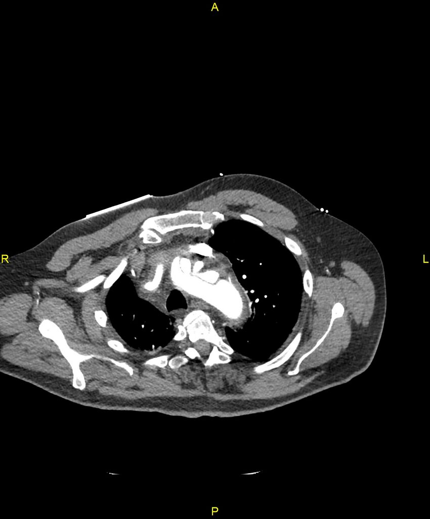 Aortic rupture (Radiopaedia 88822-105594 B 52).jpg