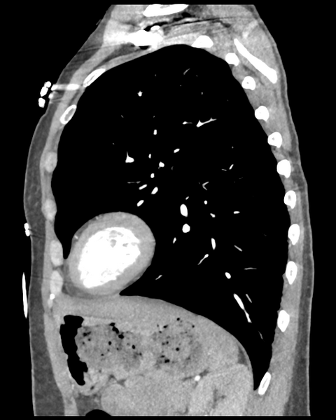 File:Aortic valve non-coronary cusp thrombus (Radiopaedia 55661-62189 D 17).png