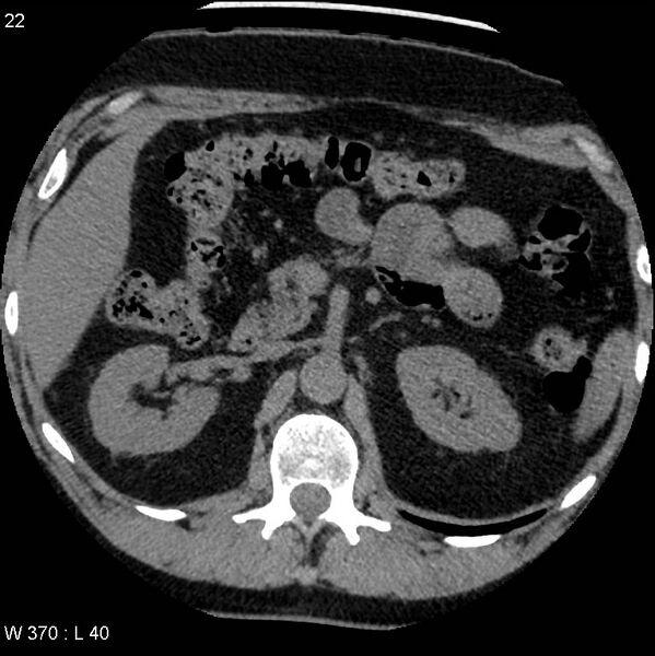 File:Appendicitis (Radiopaedia 12510-12733 Axial non-contrast 1).jpg