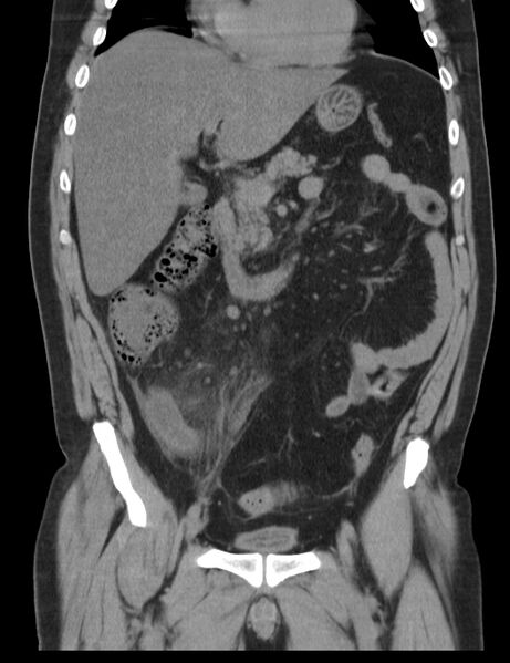 File:Appendicitis and giant appendicolith (Radiopaedia 80251-93588 Coronal non-contrast 19).jpg