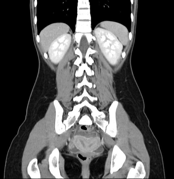 File:Appendicitis and incidental bicornuate uterus (Radiopaedia 22833-22853 D 34).jpg