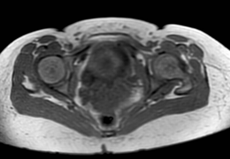 File:Appendicitis in gravida (MRI) (Radiopaedia 89433-106395 Axial T1 in-phase 67).jpg