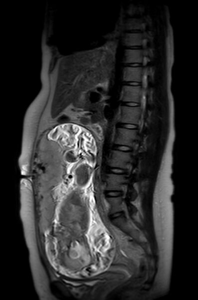 File:Appendicitis in gravida (MRI) (Radiopaedia 89433-106395 Sagittal T2 31).jpg