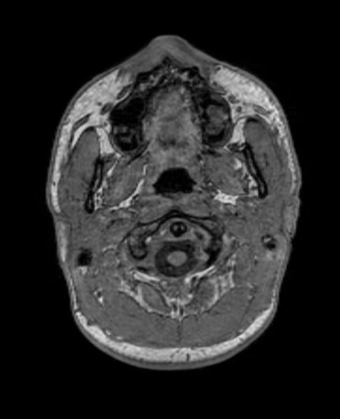 File:Arachnoid cyst- extremely large (Radiopaedia 68741-78451 Axial T1 3).jpg