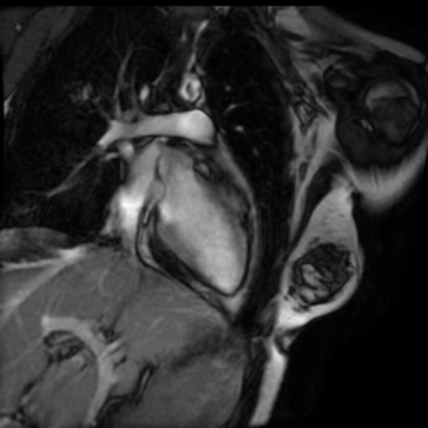 Arrhythmogenic right ventricular cardiomyopathy (Radiopaedia 87505-103850 2ch (LV) Cine SSFP 2).jpg