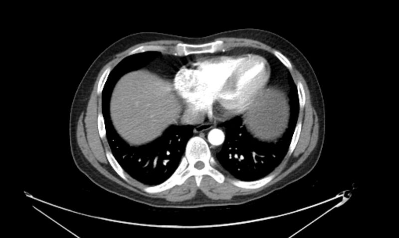 File:Arterial occlusive mesenteric ischemia (Radiopaedia 84641-100060 A 14).jpg