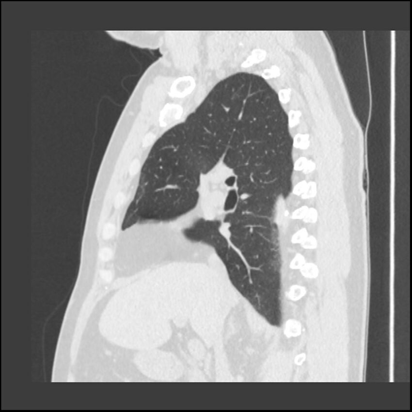 Asbestosis (Radiopaedia 45002-48961 Sagittal lung window 81).jpg