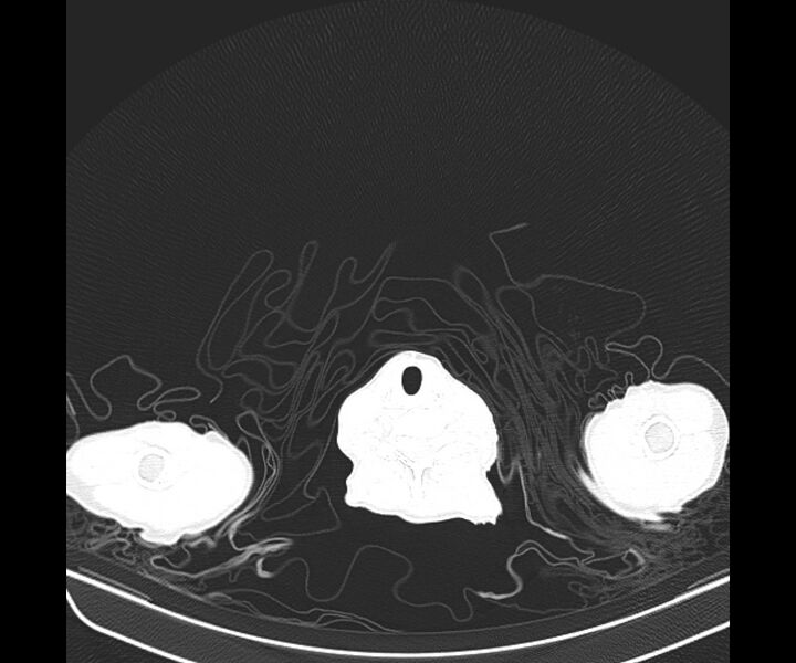 File:Aspergillomas (Radiopaedia 66779-76110 Axial lung window 1).jpg