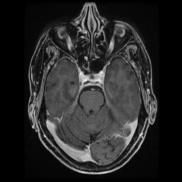 File:Atypical meningioma (Radiopaedia 45535-49629 Axial T1 C+ 29).jpg