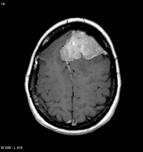File:Atypical meningioma (WHO grade II) (Radiopaedia 7762-8586 D 10).jpg