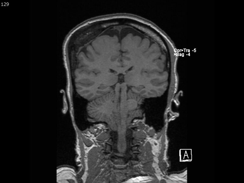 File:Atypical meningioma - intraosseous (Radiopaedia 64915-74572 Coronal T1 129).jpg