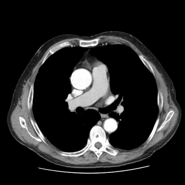 File:Autosomal dominant polycystic kidney disease (Radiopaedia 27851-28094 B 28).jpg