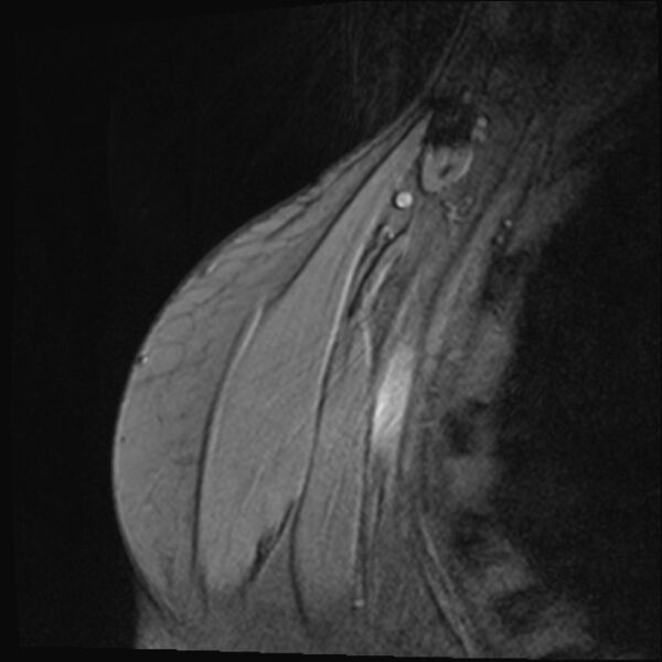 File:Avulsion fracture - greater tuberosity of humerus (Radiopaedia 71216-81515 Coronal T2 19).jpg