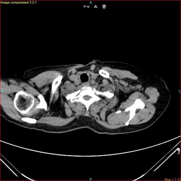 File:Azygos vein aneurysm (Radiopaedia 77824-90130 A 6).jpg