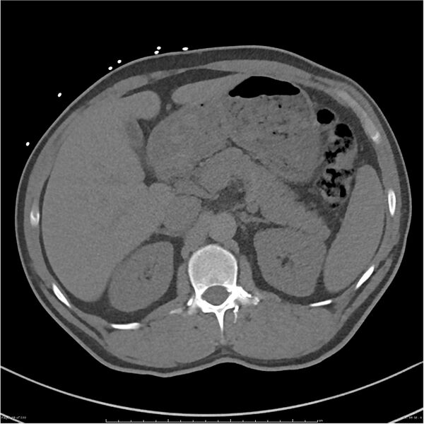 File:Azygos venous system anatomy (CT pulmonary angiography) (Radiopaedia 25928-26077 Axial C+ CTPA 98).jpg